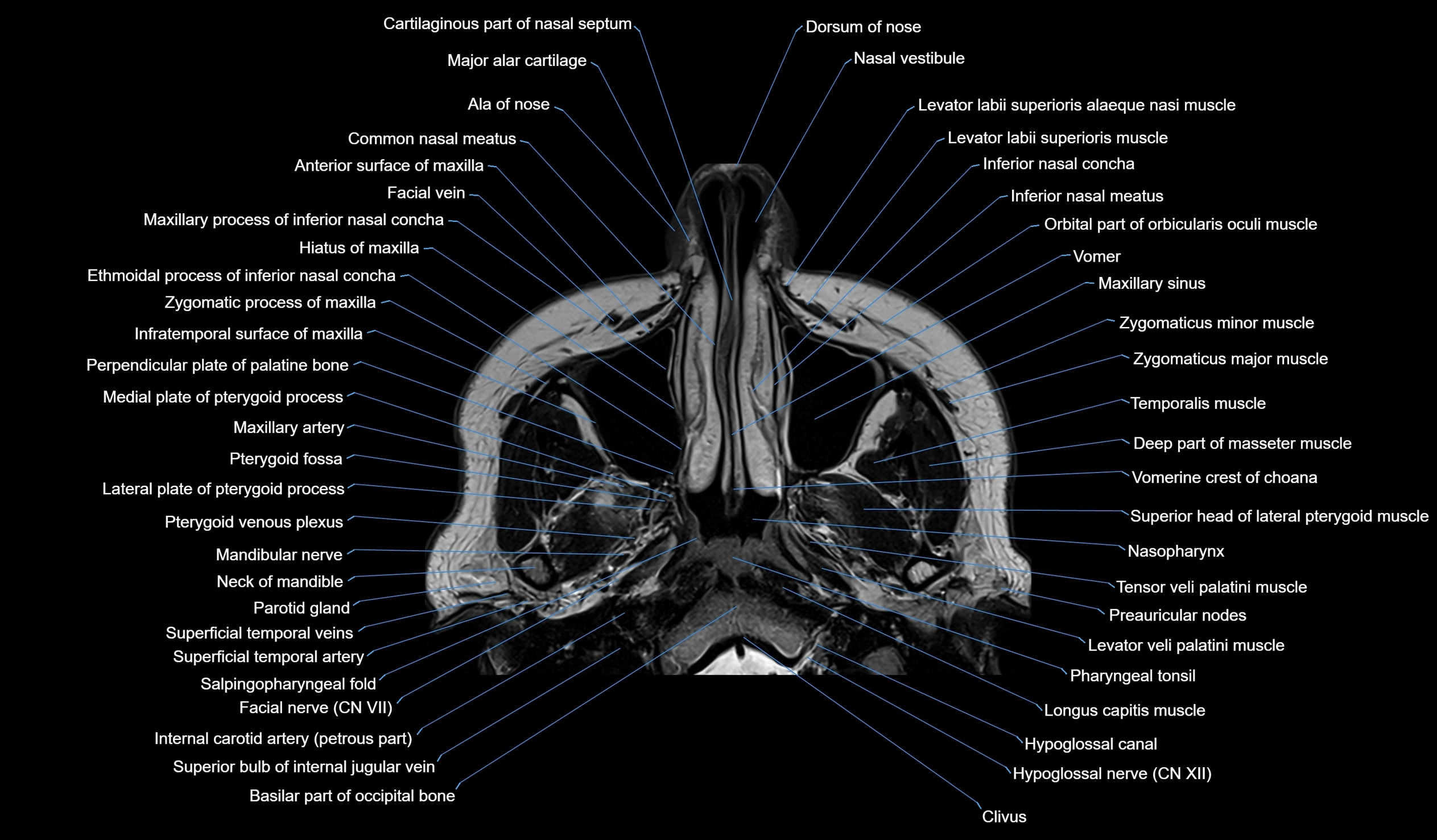 MRI face & paranasal sinuses(PNS) labelled  coronal  cross sectional anatomy 3T radiology  image-img-00001-00009.webp